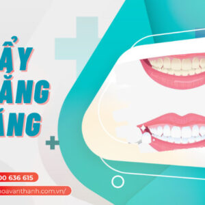tẩy trắng răng